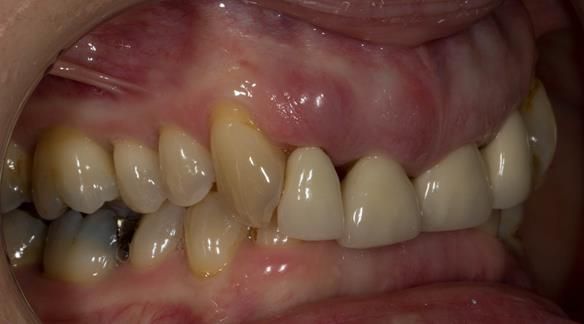 Figure 7 Overeruption of the upper and lower anterior segments with traumatic overbite and aesthetic failure