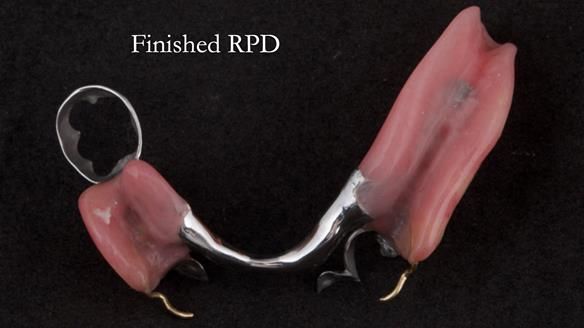 Eileen's transformation with upper and lower RPDs of Scandinavian hygienic design FULL PROTOCOL