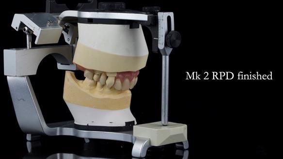 Newsletter 71 Jean’s Class I Mod III RPD: See my mistakes Fractured Mk1 to a Stronger Mk2 RPD (4 years on)