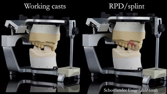 Read Newsletter 67 - Brian's COMBAT DENTURE Case Study