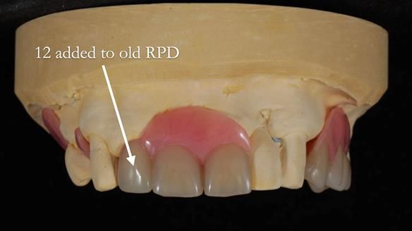 Managing Edgar “THE SCEPTIC” with an RPD/Splint FULL CASE