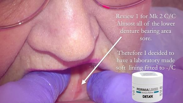 Replacing Madeline’s Complete denture FULL PROTOCOL