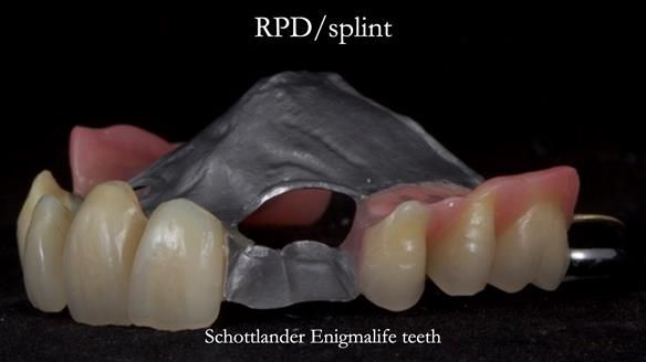 Managing Edgar “THE SCEPTIC” with an RPD/Splint FULL CASE