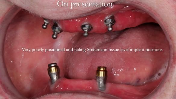 Newsletter 65 Marisa Provision of Complete Dentures on badly placed implants