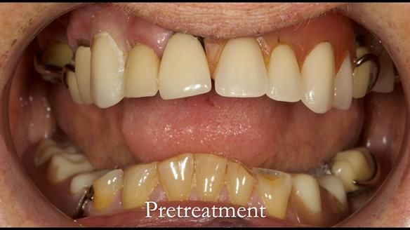 Eileen's transformation with upper and lower RPDs of Scandinavian hygienic design FULL PROTOCOL