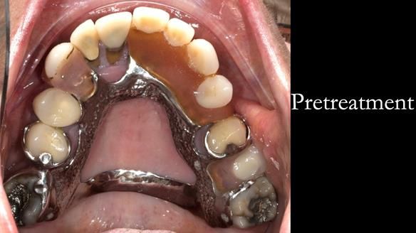 Eileen's transformation with upper and lower RPDs of Scandinavian hygienic design FULL PROTOCOL