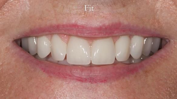 Newsletter 68 Restoring Jan’s Smile: Complete Dentures Inspired by Her Daughter’s Teeth - Post Mouth Surgery