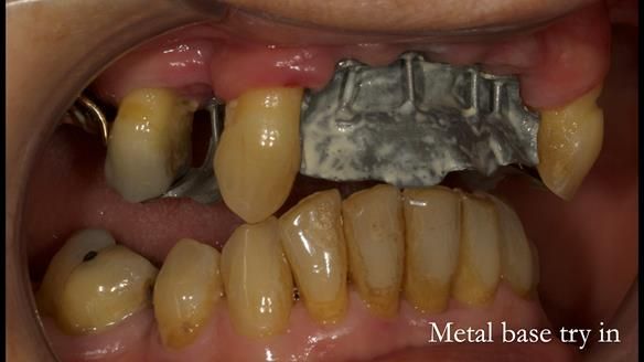 Newsletter 71 Jean’s Class I Mod III RPD: See my mistakes Fractured Mk1 to a Stronger Mk2 RPD (4 years on)