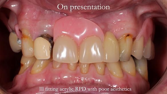 Managing Edgar “THE SCEPTIC” with an RPD/Splint FULL CASE