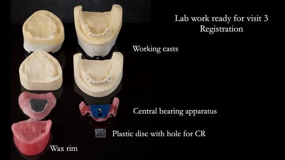 Solving Linda’s Failed “All on 4” implant bridges - full protocol Newsletter 42