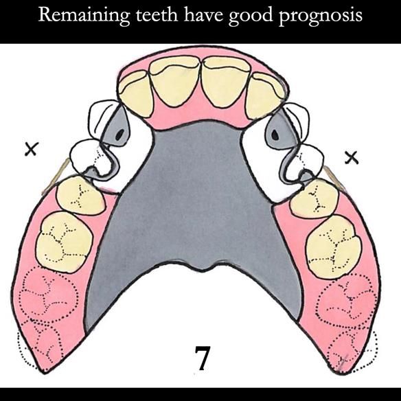 Universal Scandinavian partial denture designs