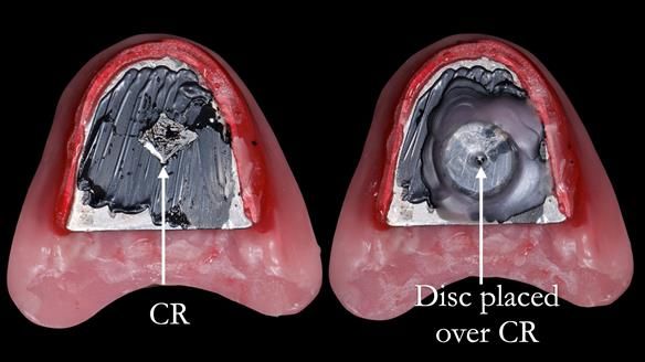 Replacing Madeline’s Complete denture FULL PROTOCOL