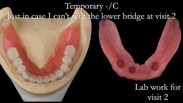 Newsletter 49 Managing Estelle’s failing implants with dentures FULL PROTOCOL