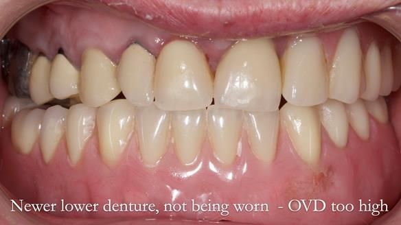 Newsletter 44 - extreme removable prosthodontics – engineering a super-strong and ultra-thin over denture