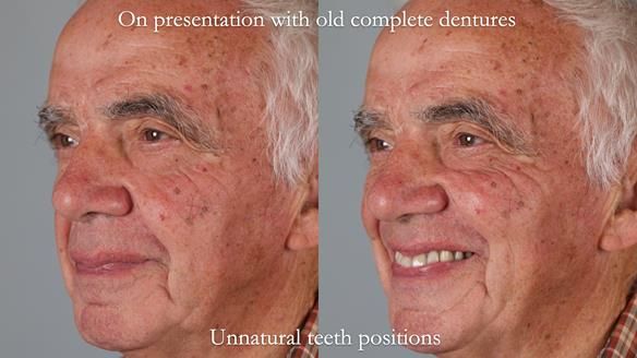 Newsletter 74: Ken’s Case Study Complete Dentures - Life Like and Age Appropriate