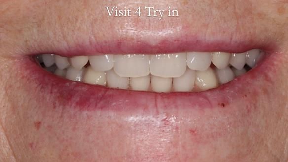 Newsletter 48 Mavis's Complete denture FULL PROTOCOL