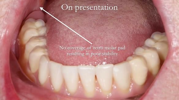 Replacing Madeline’s Complete denture FULL PROTOCOL