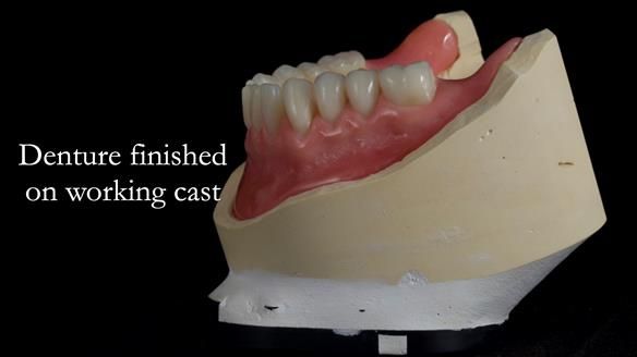 Newsletter 68 Restoring Jan’s Smile: Complete Dentures Inspired by Her Daughter’s Teeth - Post Mouth Surgery