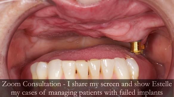 Newsletter 49 Managing Estelle’s failing implants with dentures FULL PROTOCOL