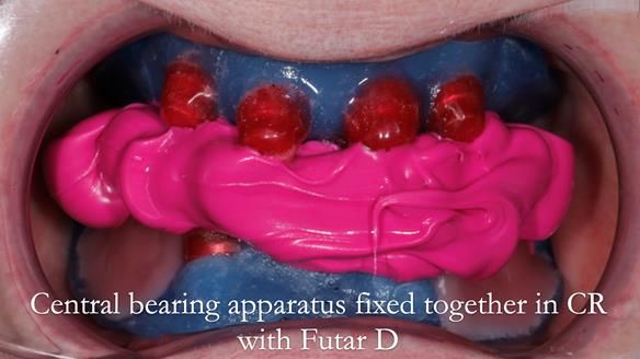 Newsletter 65 Marisa Provision of Complete Dentures on badly placed implants