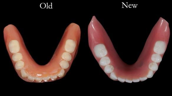 Newsletter 65 Marisa Provision of Complete Dentures on badly placed implants