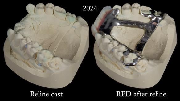 Newsletter 66 Long term case study. Life changing metal based RPD made for Anna