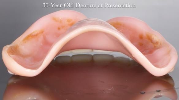 Newsletter 68 Restoring Jan’s Smile: Complete Dentures Inspired by Her Daughter’s Teeth - Post Mouth Surgery