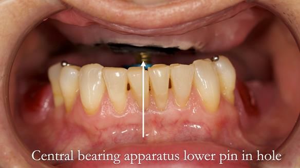 Solving Linda’s Failed “All on 4” implant bridges - full protocol Newsletter 42