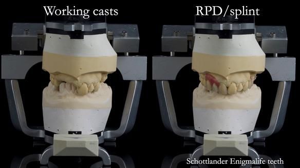 Read Newsletter 67 - Brian's COMBAT DENTURE Case Study