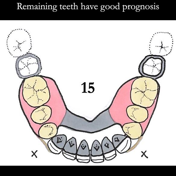 Universal Scandinavian partial denture designs