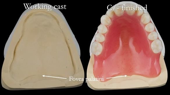 Replacing Madeline’s Complete denture FULL PROTOCOL