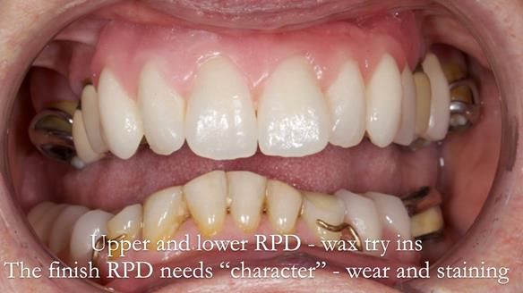 Eileen's transformation with upper and lower RPDs of Scandinavian hygienic design FULL PROTOCOL