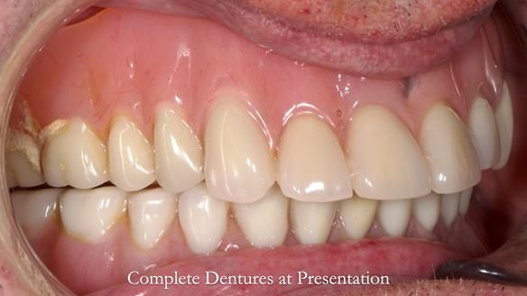 Newsletter 74: Ken’s Case Study Complete Dentures - Life Like and Age Appropriate