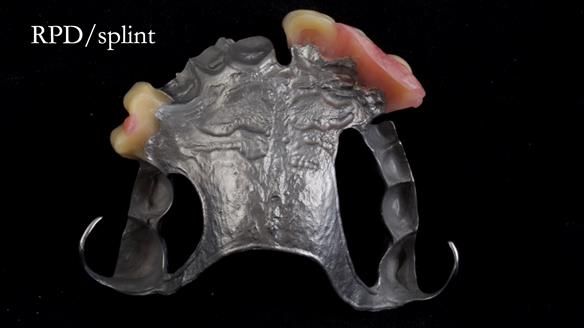 Read Newsletter 67 - Brian's COMBAT DENTURE Case Study