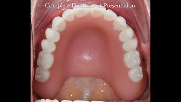 Newsletter 70 Complete Denture Treatment for Kate: A Case Study on Natural-Looking Dentures and Implant-Supported Overdentures