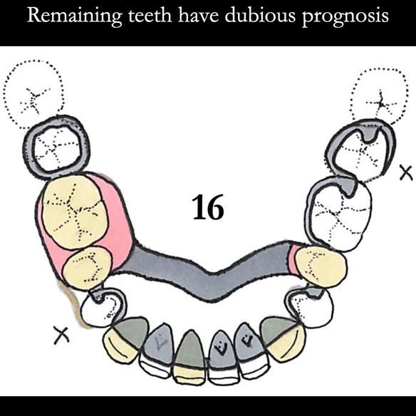 Universal Scandinavian partial denture designs