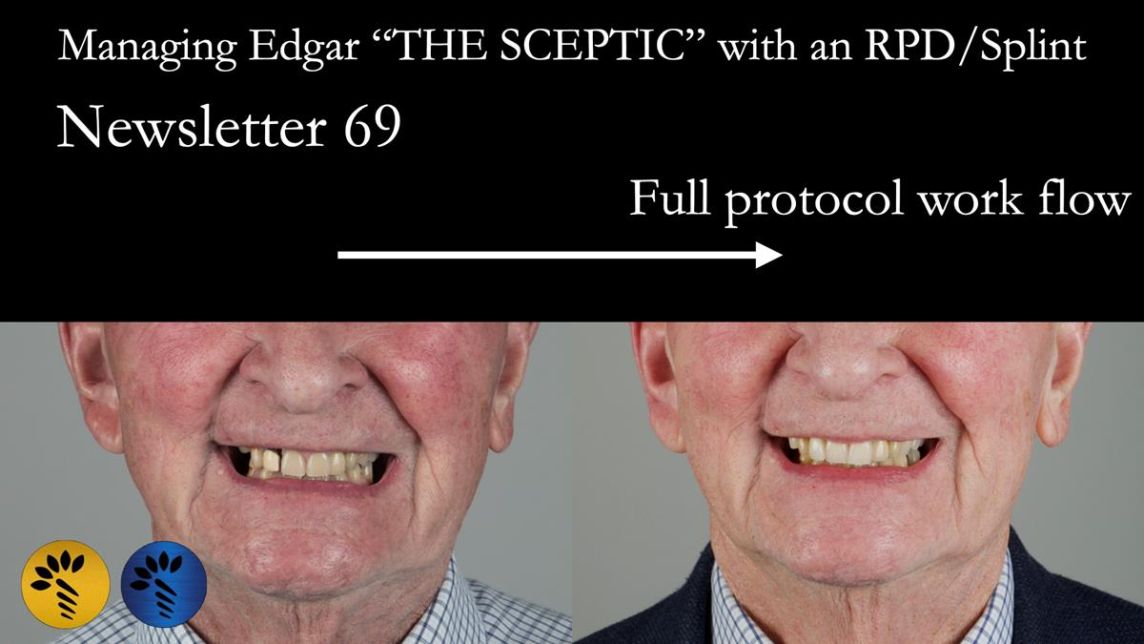 Managing Edgar “THE SCEPTIC” with an RPD/Splint FULL CASE