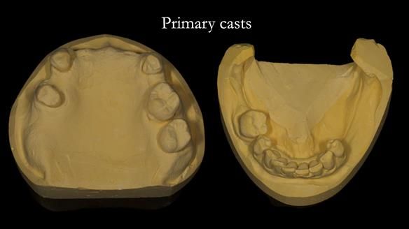 Newsletter 71 Jean’s Class I Mod III RPD: See my mistakes Fractured Mk1 to a Stronger Mk2 RPD (4 years on)