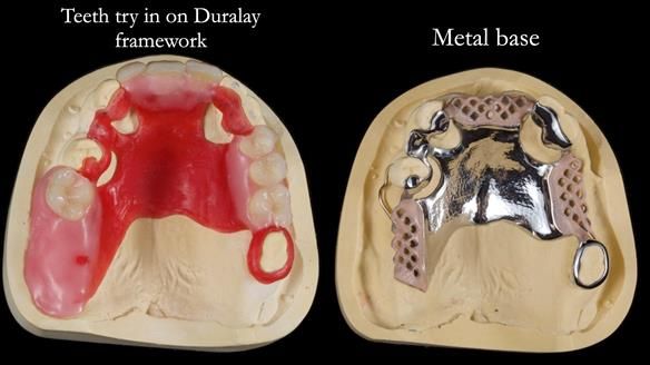 Managing Edgar “THE SCEPTIC” with an RPD/Splint FULL CASE