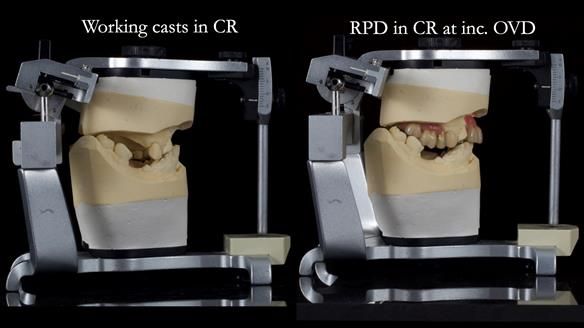 How Keith’s combat denture transformed his life – Newsletter 73