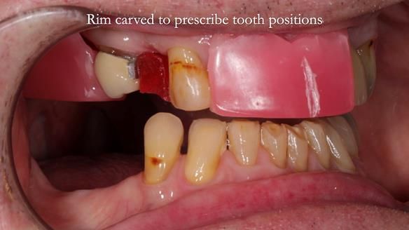 Managing Edgar “THE SCEPTIC” with an RPD/Splint FULL CASE