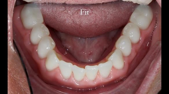 Newsletter 68 Restoring Jan’s Smile: Complete Dentures Inspired by Her Daughter’s Teeth - Post Mouth Surgery