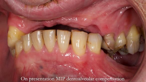 How Keith’s combat denture transformed his life – Newsletter 73