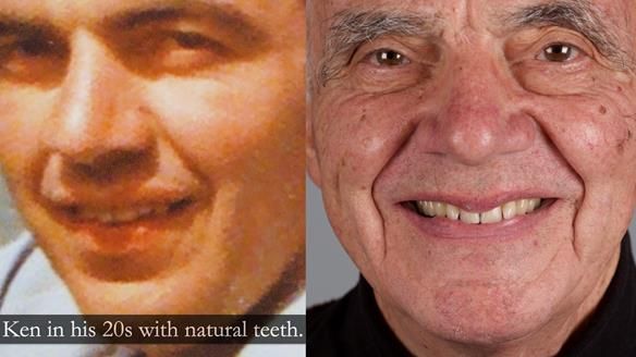 Newsletter 74: Ken’s Case Study Complete Dentures - Life Like and Age Appropriate