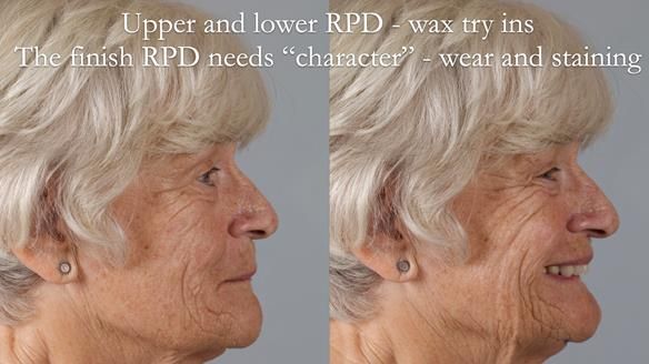 Eileen's transformation with upper and lower RPDs of Scandinavian hygienic design FULL PROTOCOL