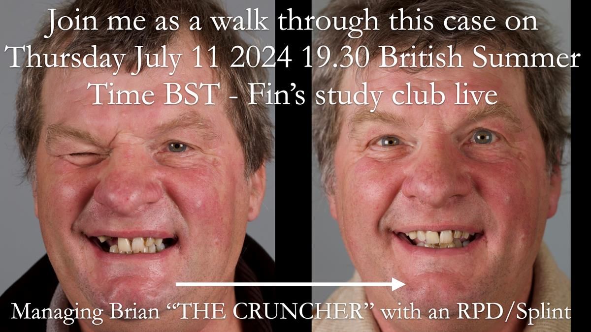 Read Newsletter 67 - Brian's COMBAT DENTURE Case Study