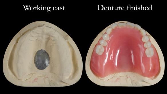 Newsletter 70 Complete Denture Treatment for Kate: A Case Study on Natural-Looking Dentures and Implant-Supported Overdentures