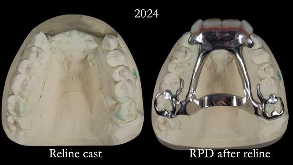 Newsletter 66 Long term case study. Life changing metal based RPD made for Anna