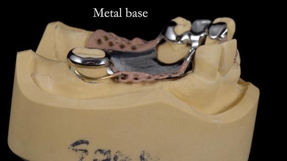 Managing Edgar “THE SCEPTIC” with an RPD/Splint FULL CASE