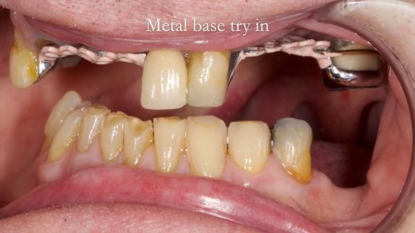 Managing Edgar “THE SCEPTIC” with an RPD/Splint FULL CASE